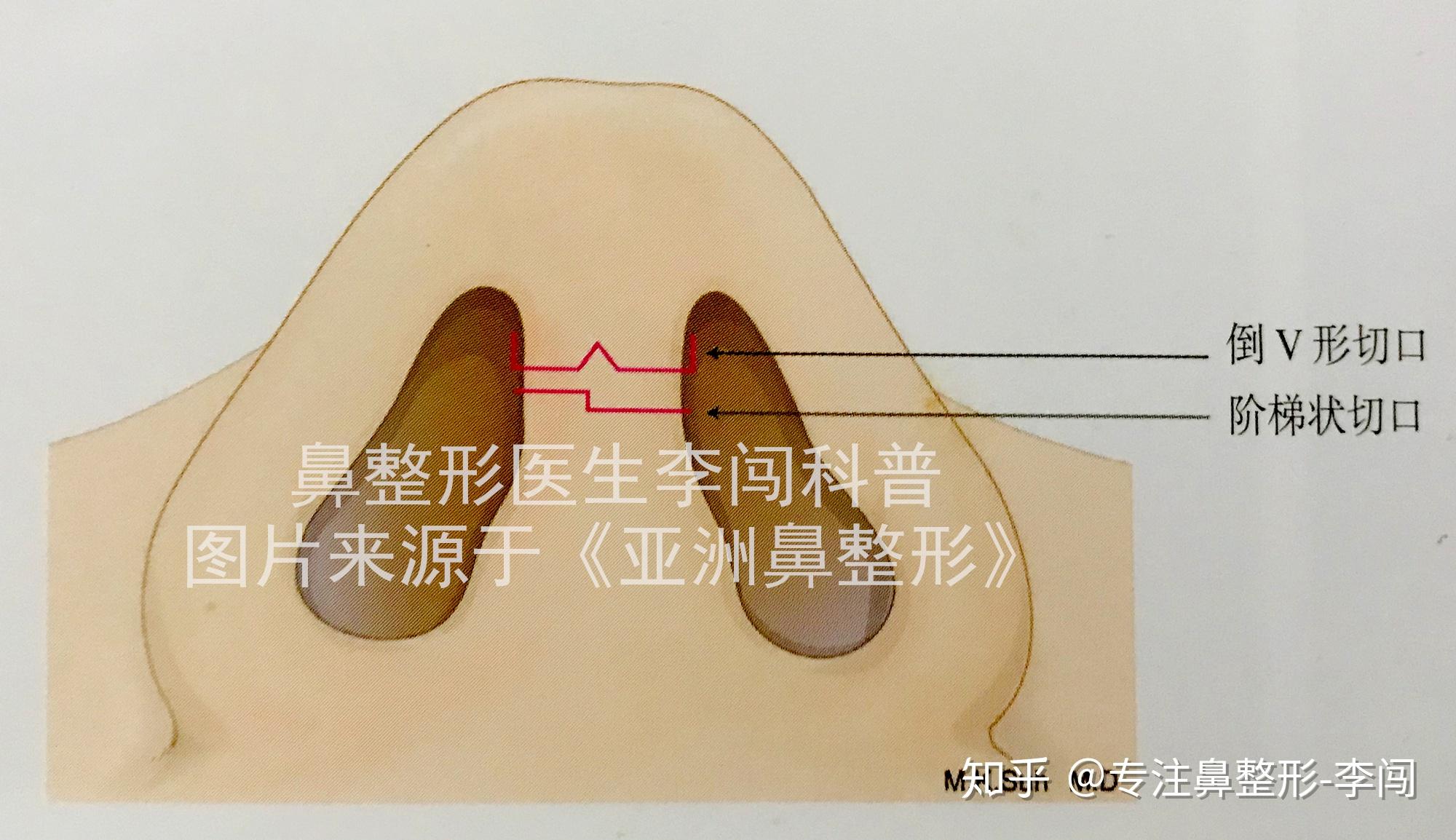 鼻小柱切口易留疤隆鼻能选择鼻内切口吗