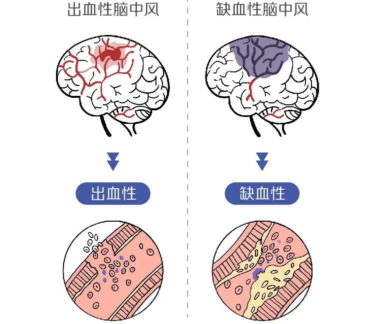 夏天爱打盹可能是脑中风的先兆! - 知乎