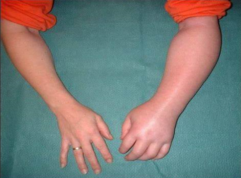 拒绝小胖手作业治疗干预肩手综合征