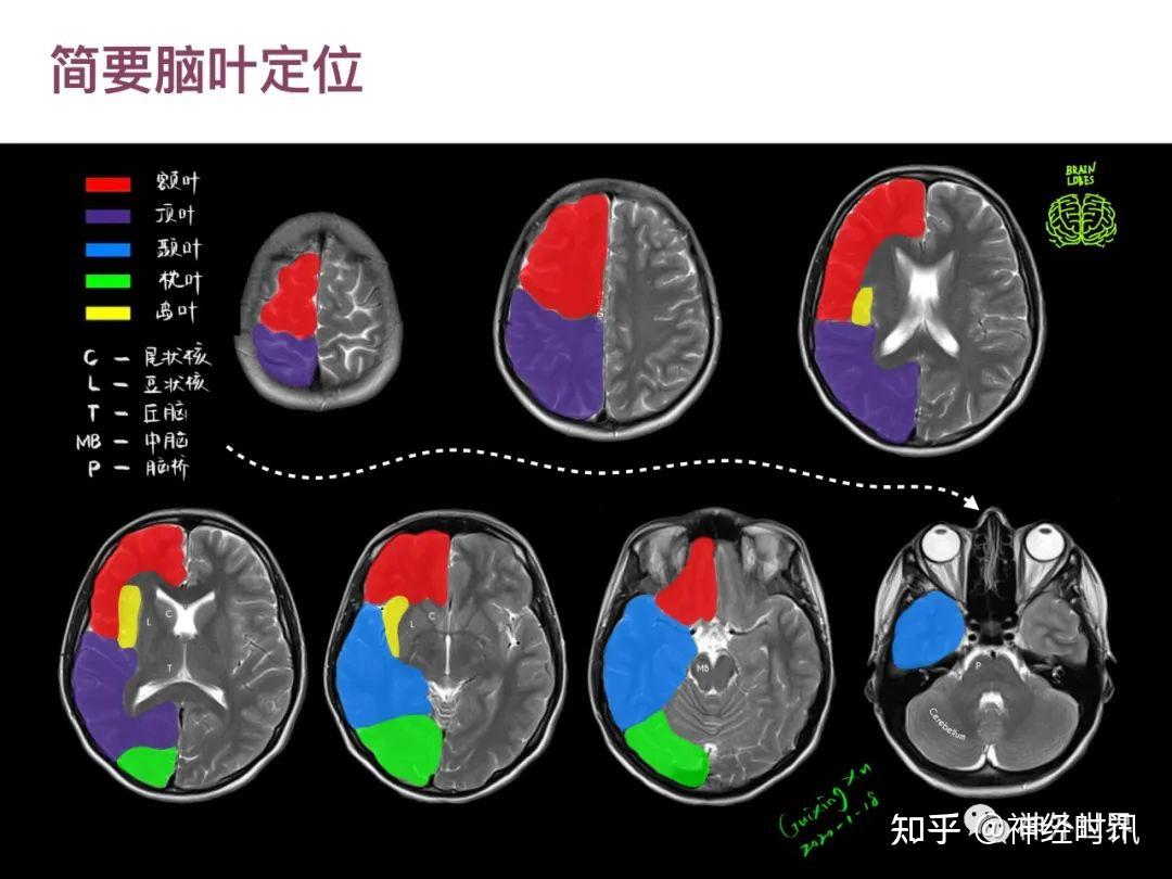 最全影像总结!颅内病变MR、CT 的阅片技巧 - 知乎