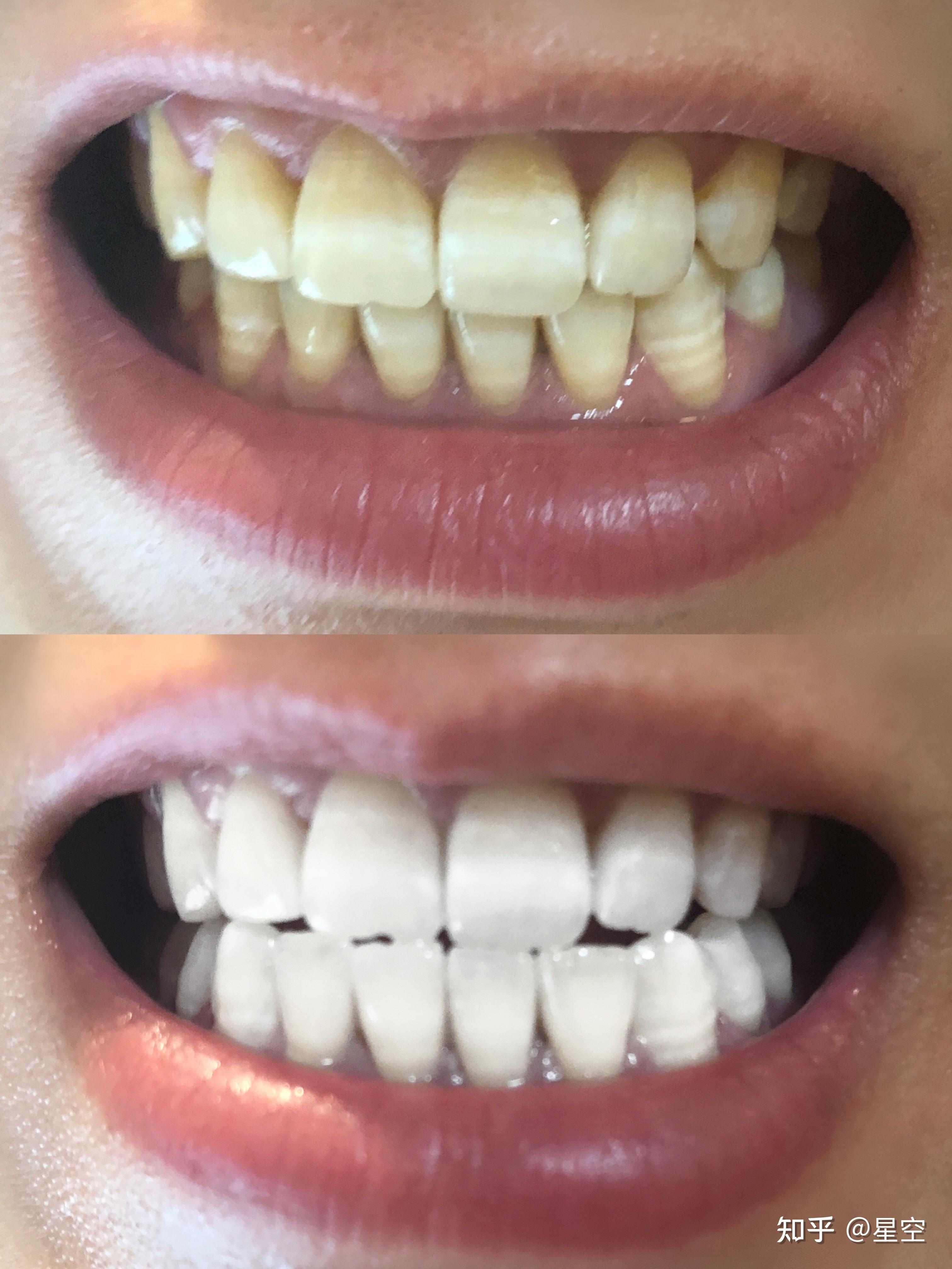 牙贼黄求一款真正能白牙的产品我真的会谢