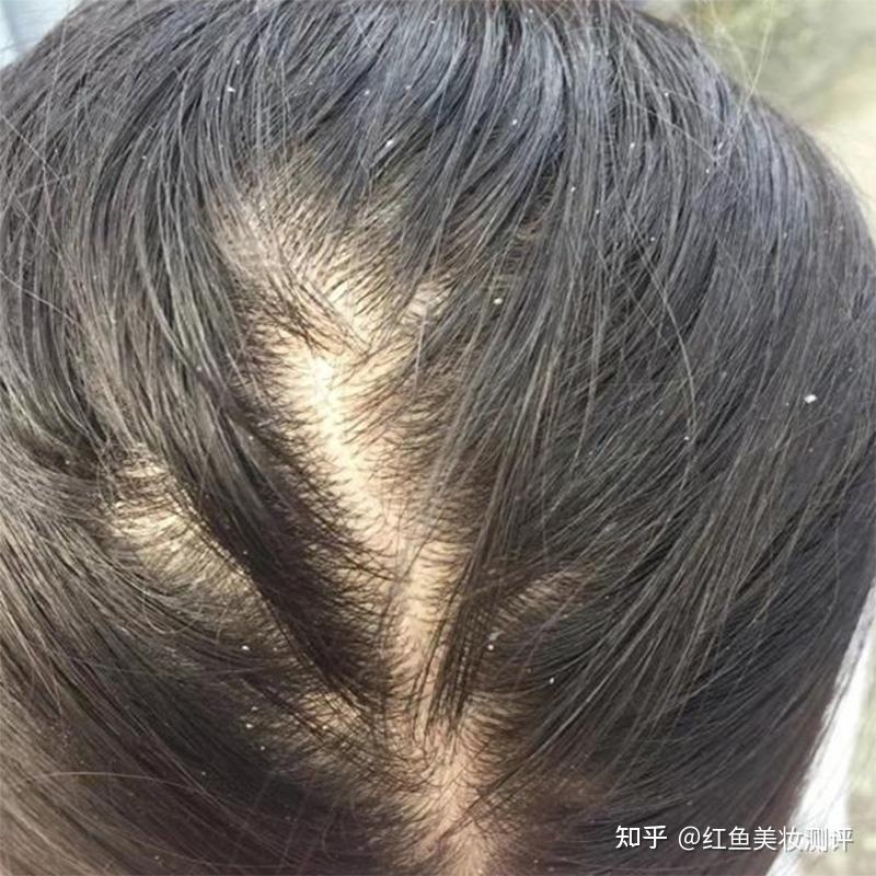 去屑控油洗发水哪个牌子最好?去屑止痒公认最好的洗发水 - 知乎