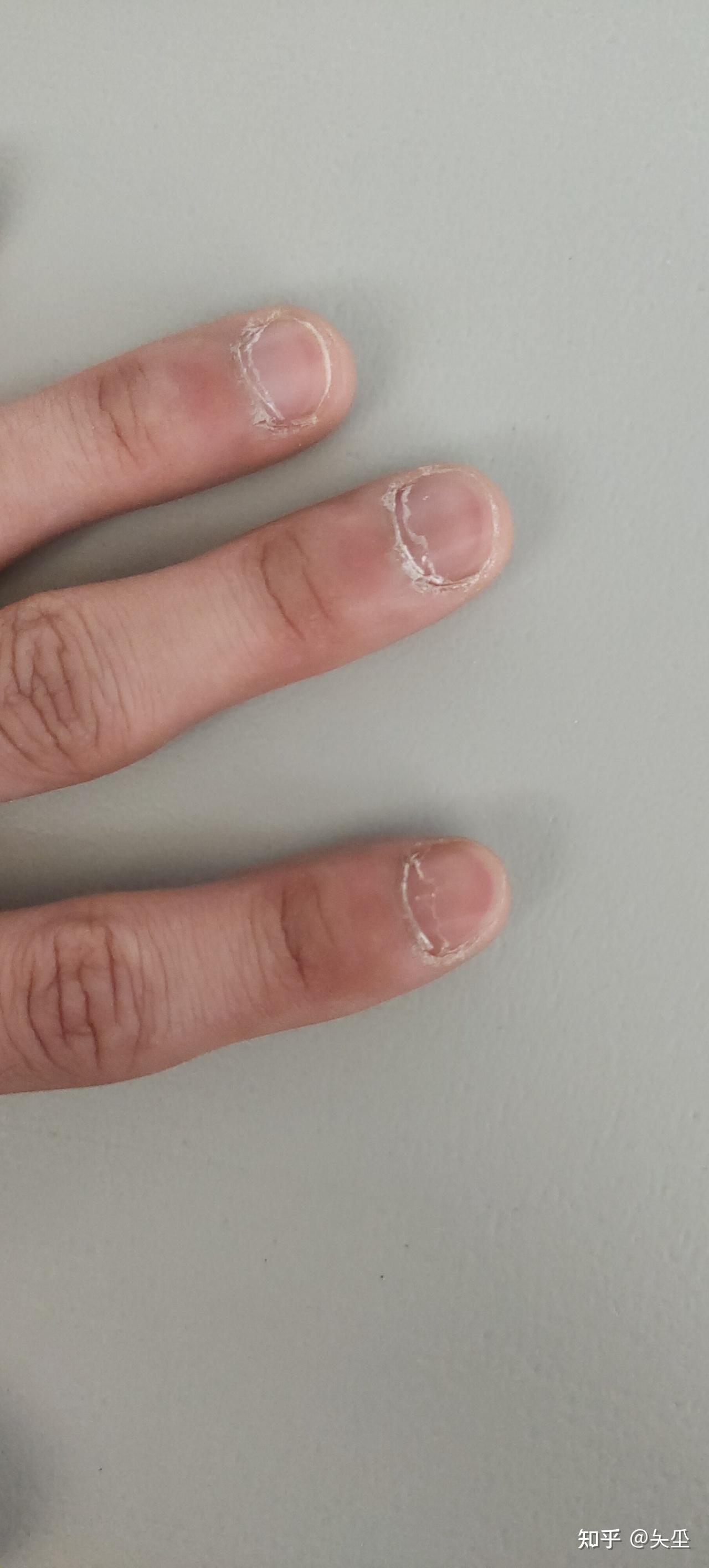 指甲根部手指肉的部分发白而且还有倒刺还有皮皮怎么回事