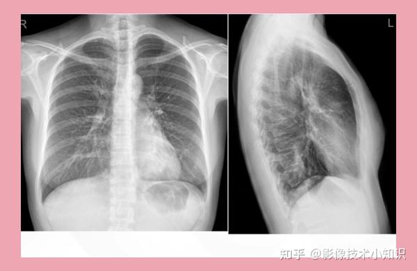 如何识别侧位胸片是左侧位还是右侧位 - 知乎