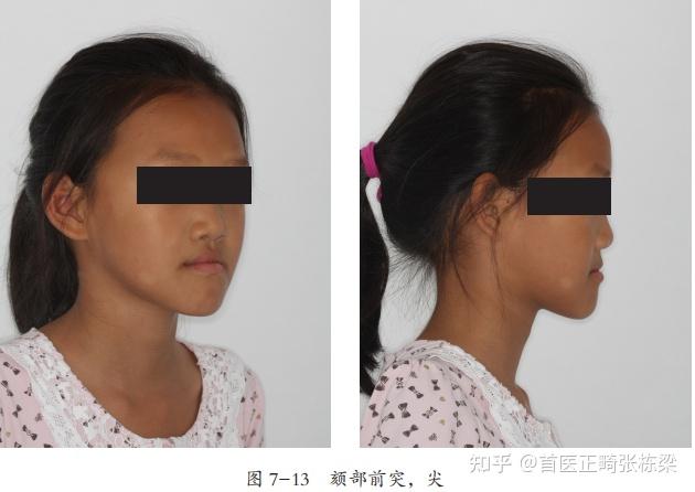 这种遗传性质使得一些孩子天生就具有形成骨