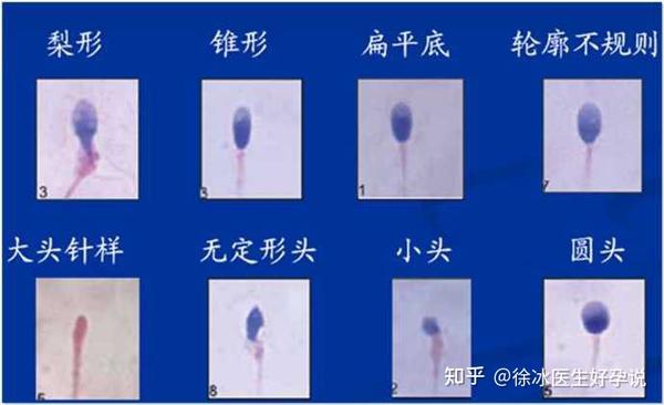 精子畸形率高,会生畸形儿吗? - 知乎