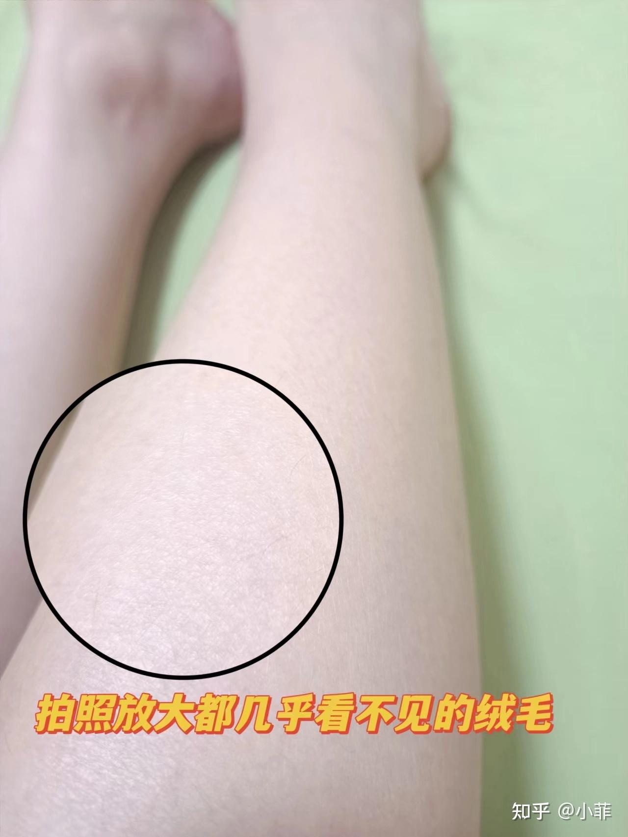 脱毛仪ulikeair3原理 脱毛仪ulikeair3原理