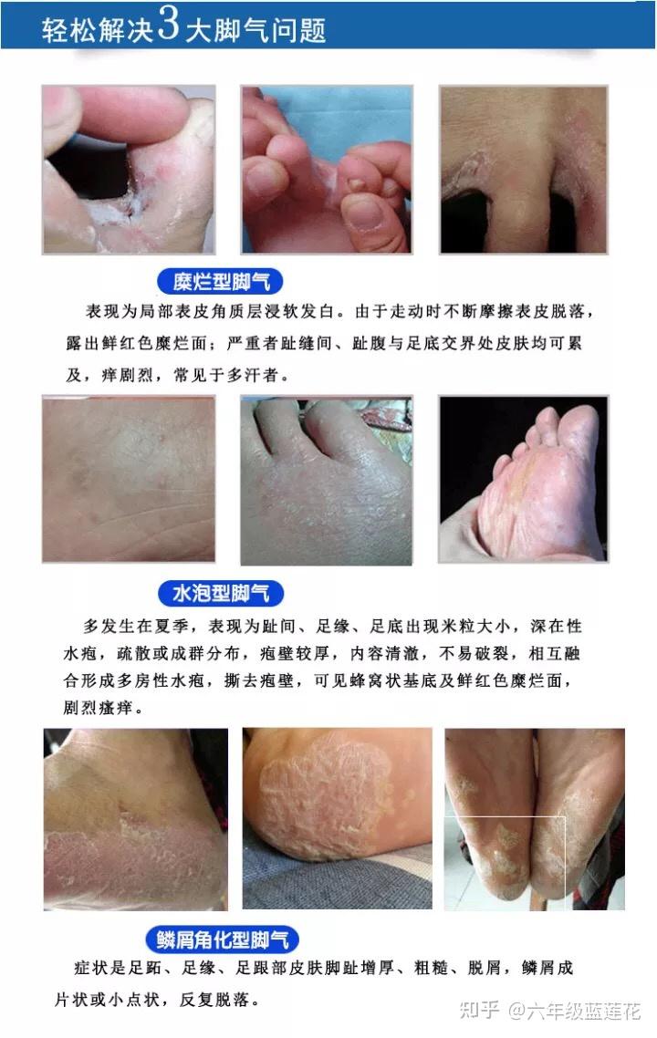 女生有脚气是种什么体验