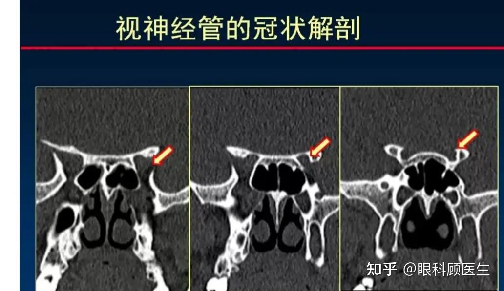 了解眼眶的解剖 - 知乎