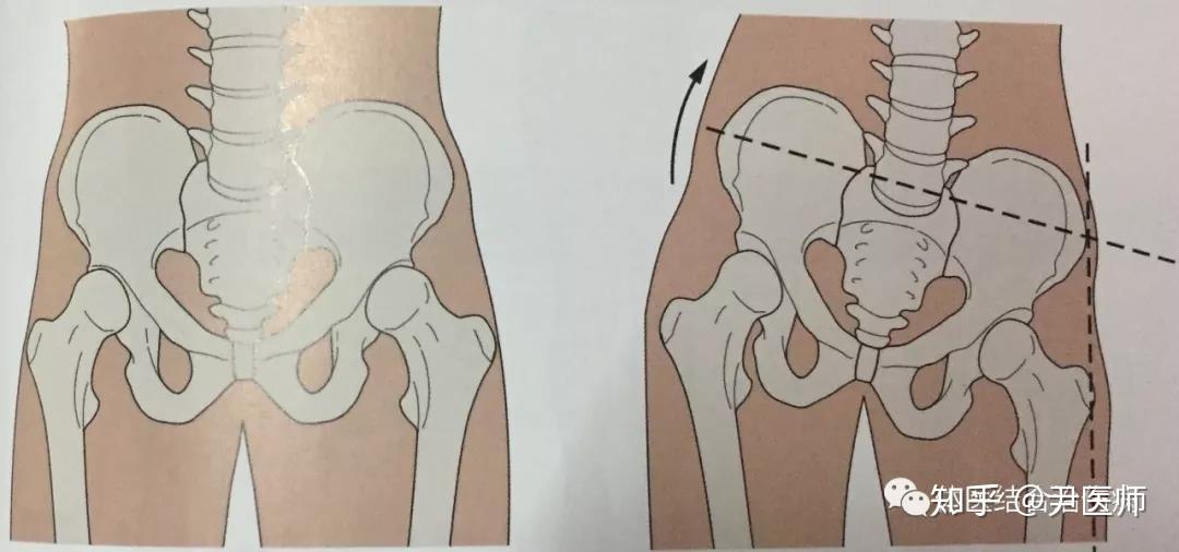 他的骨盆表现为"左高右低","顺时针旋转(右旋).