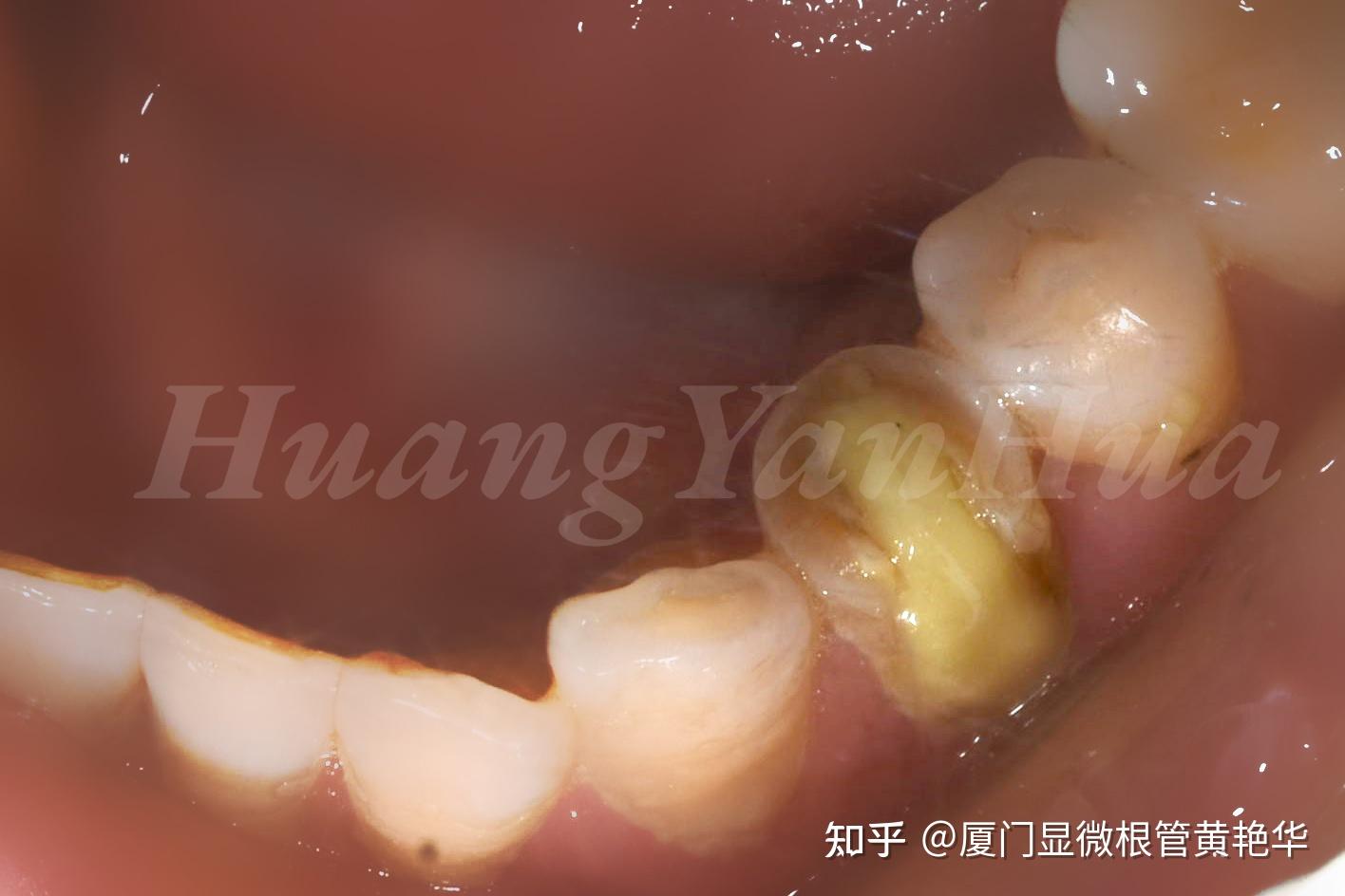 下颌第二磨牙根管再治疗 |雷捷凯使用C-Root SP充填案例 - 知乎