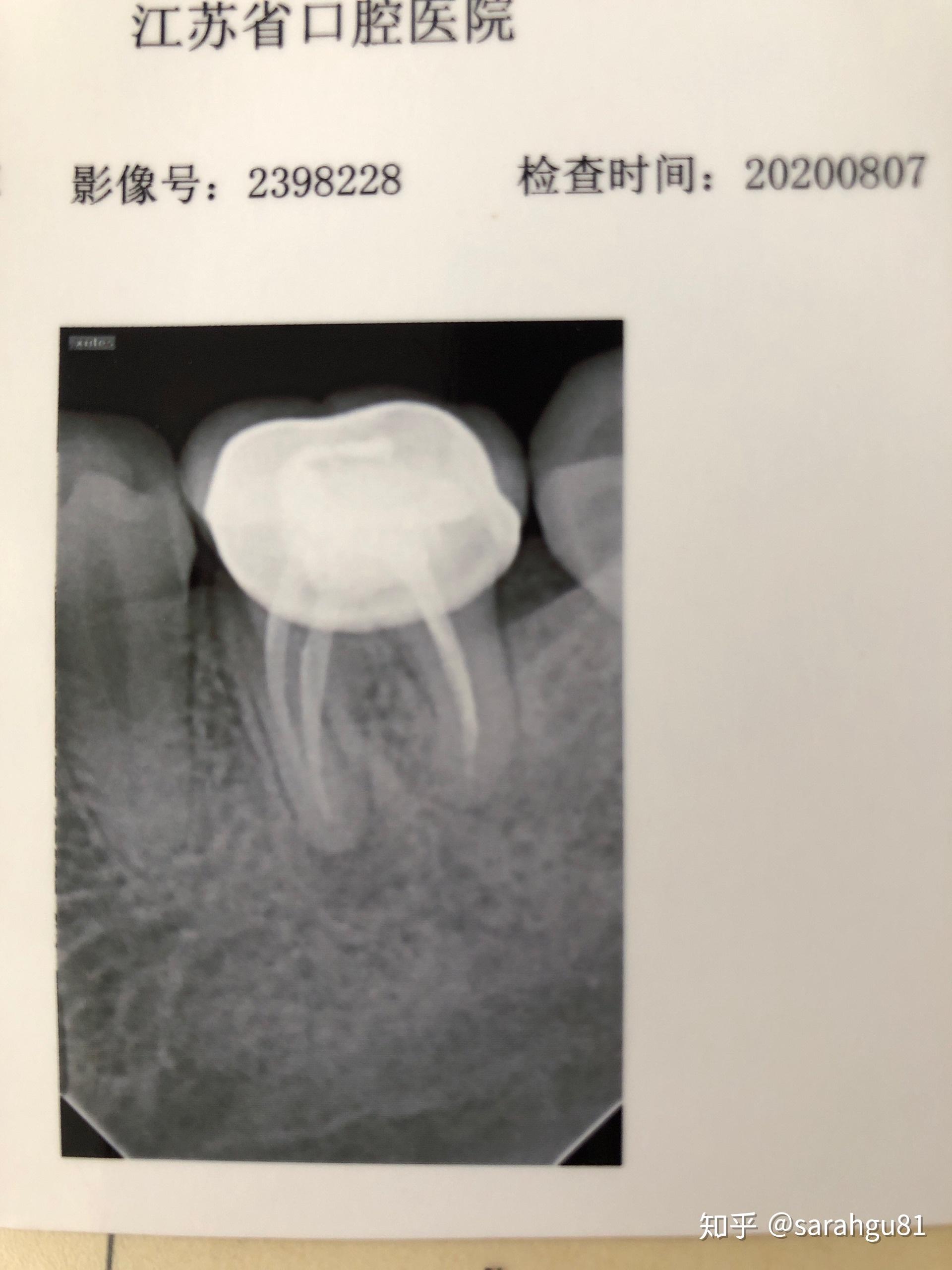 根尖周肉芽肿x线图片图片