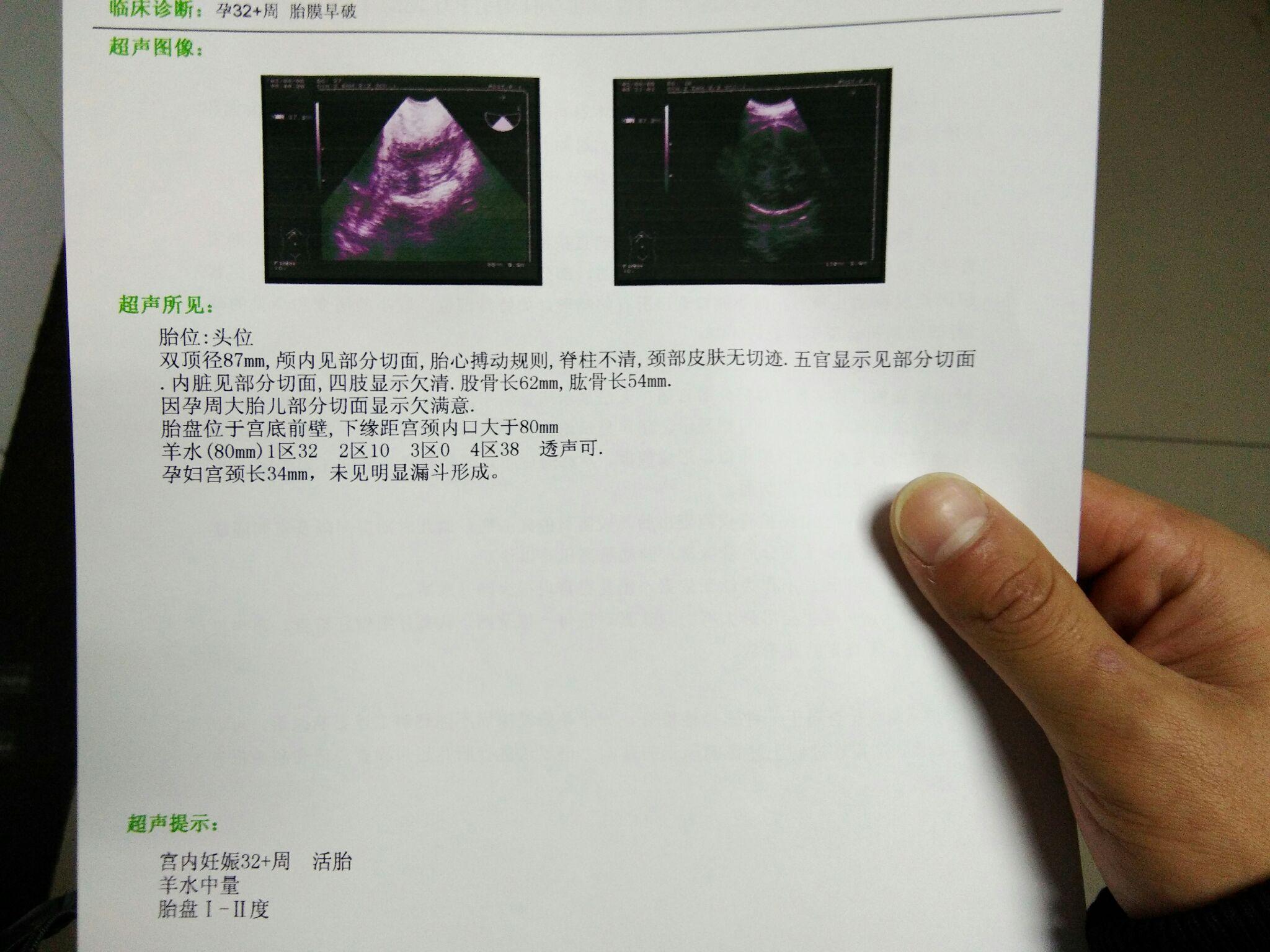 妇儿孕33周胎膜早破,现在在医院,刚做了B超,求