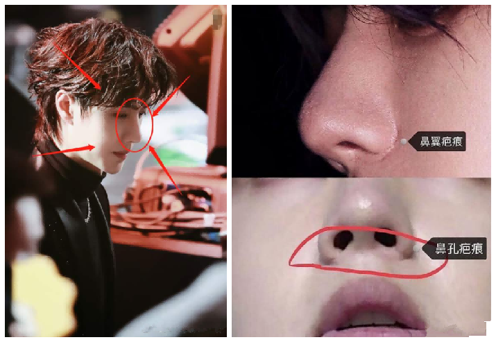 王一博五官中鼻子受到的质疑最多的,有说他去垫过山根,也有说缩了鼻翼