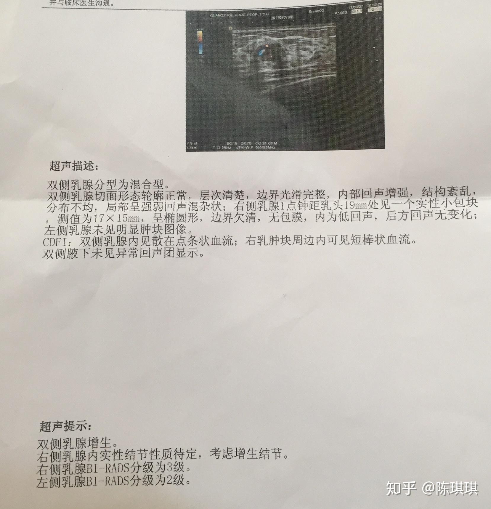 记一次乳腺纤维瘤开刀手术