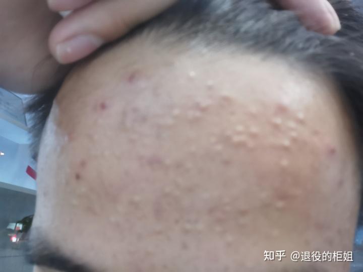 闭口痘是什么?如何正确的去除闭口痘? - 知乎