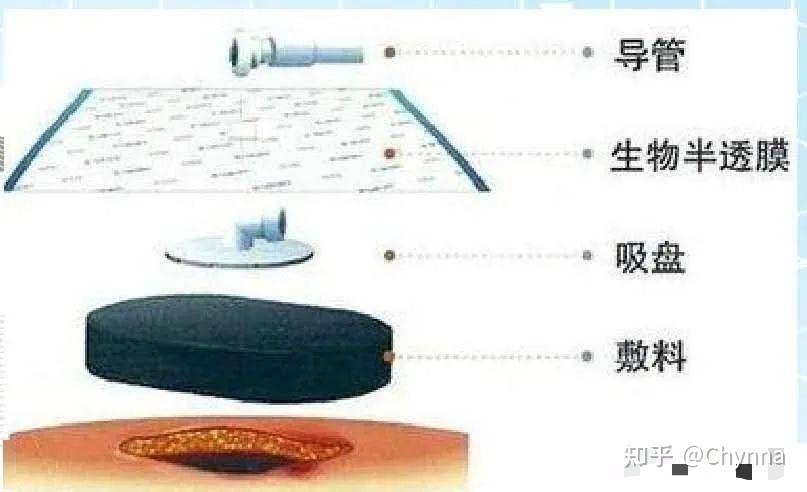 怎样对付难愈合的伤口？ - 知乎