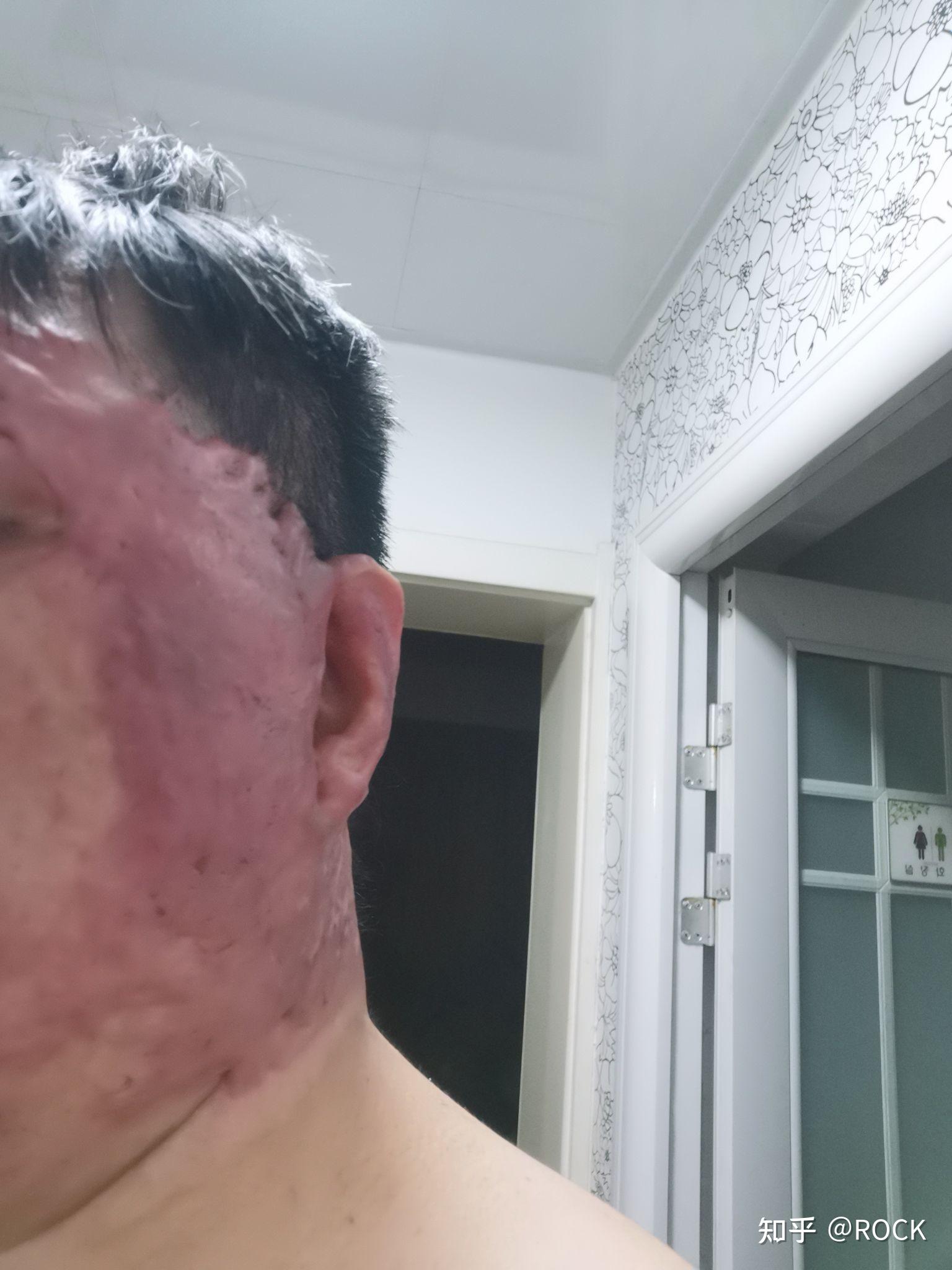 脸部大面积烧伤我该怎么面对他人