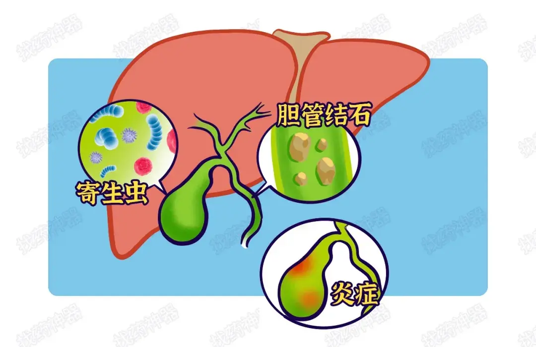 膽道癌治療迎來新希望,不再