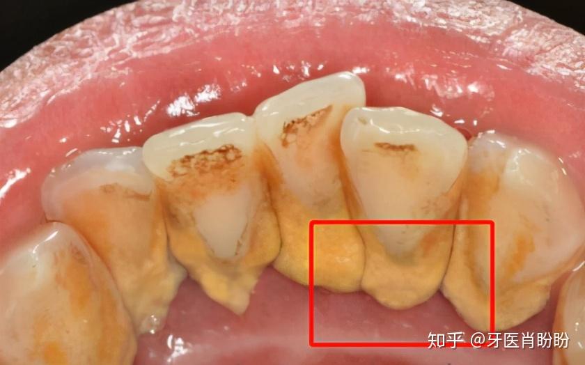 牙齿出现黑三角图片