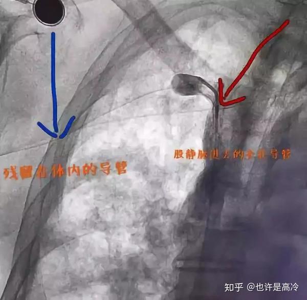 PICC导管,不知道这些千万别拔! - 知乎