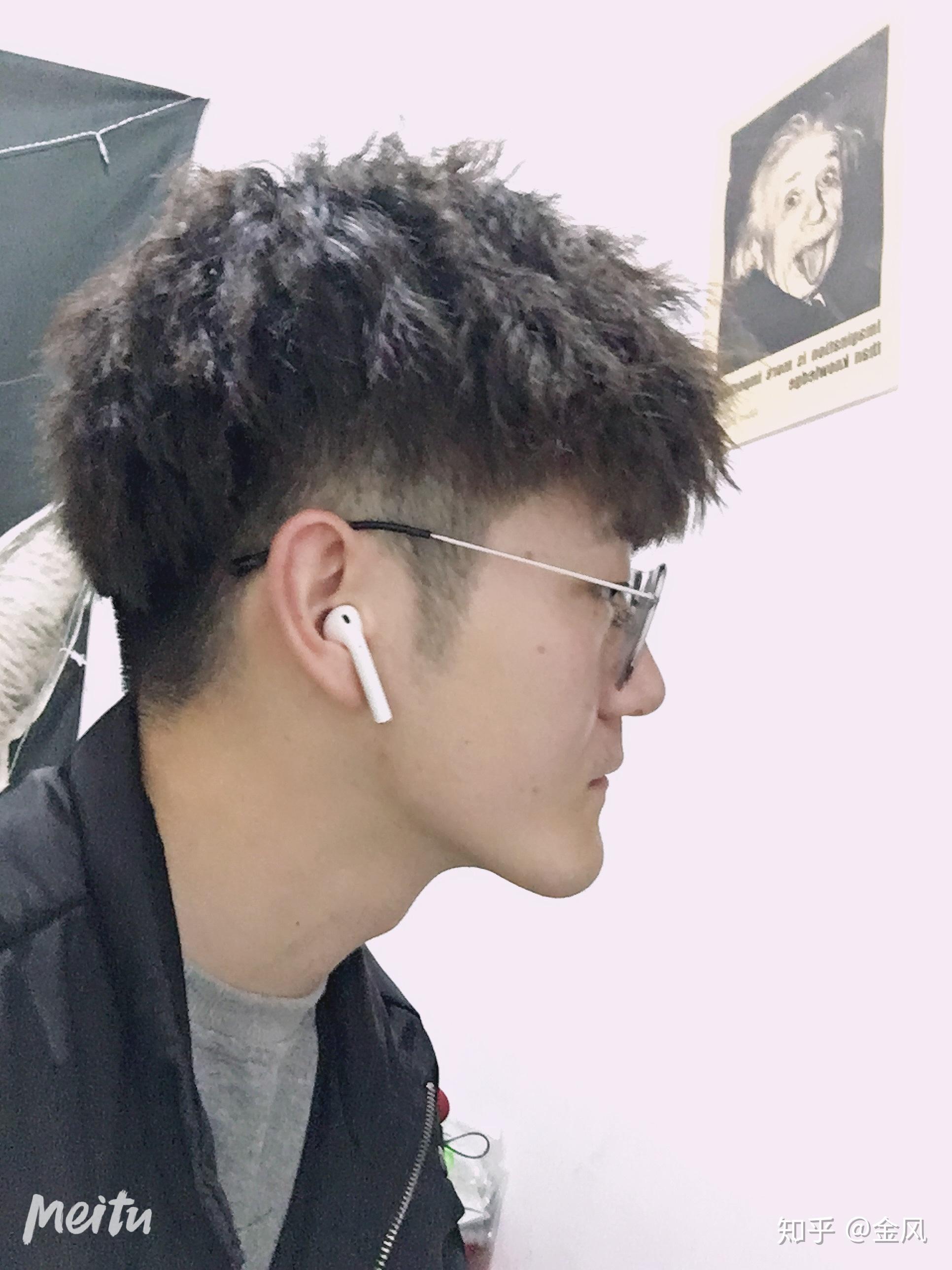 翘下巴月亮脸怎么治疗