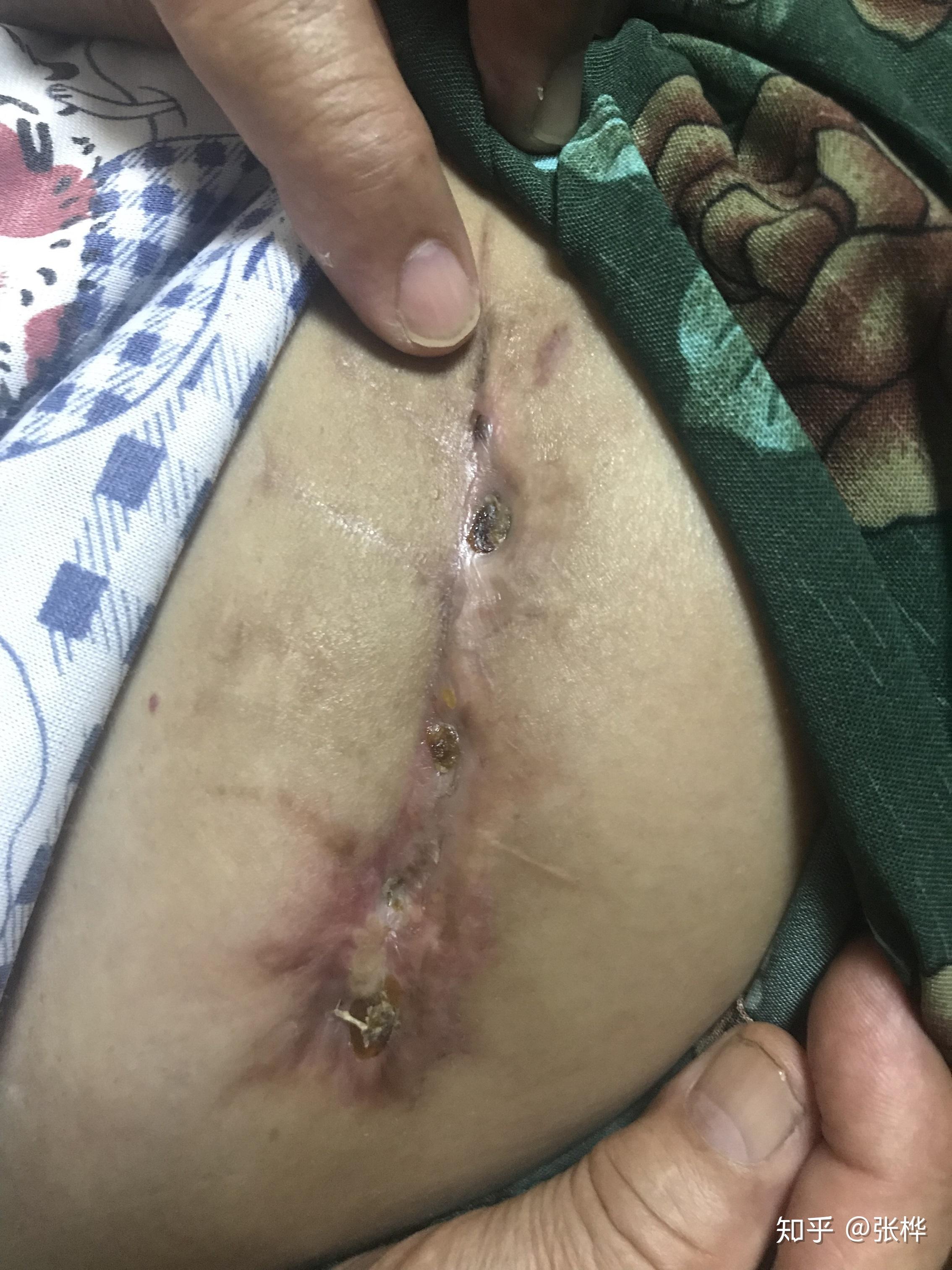 医理求真——右髋部血肿清除术后2月伤口不愈合 - 知乎