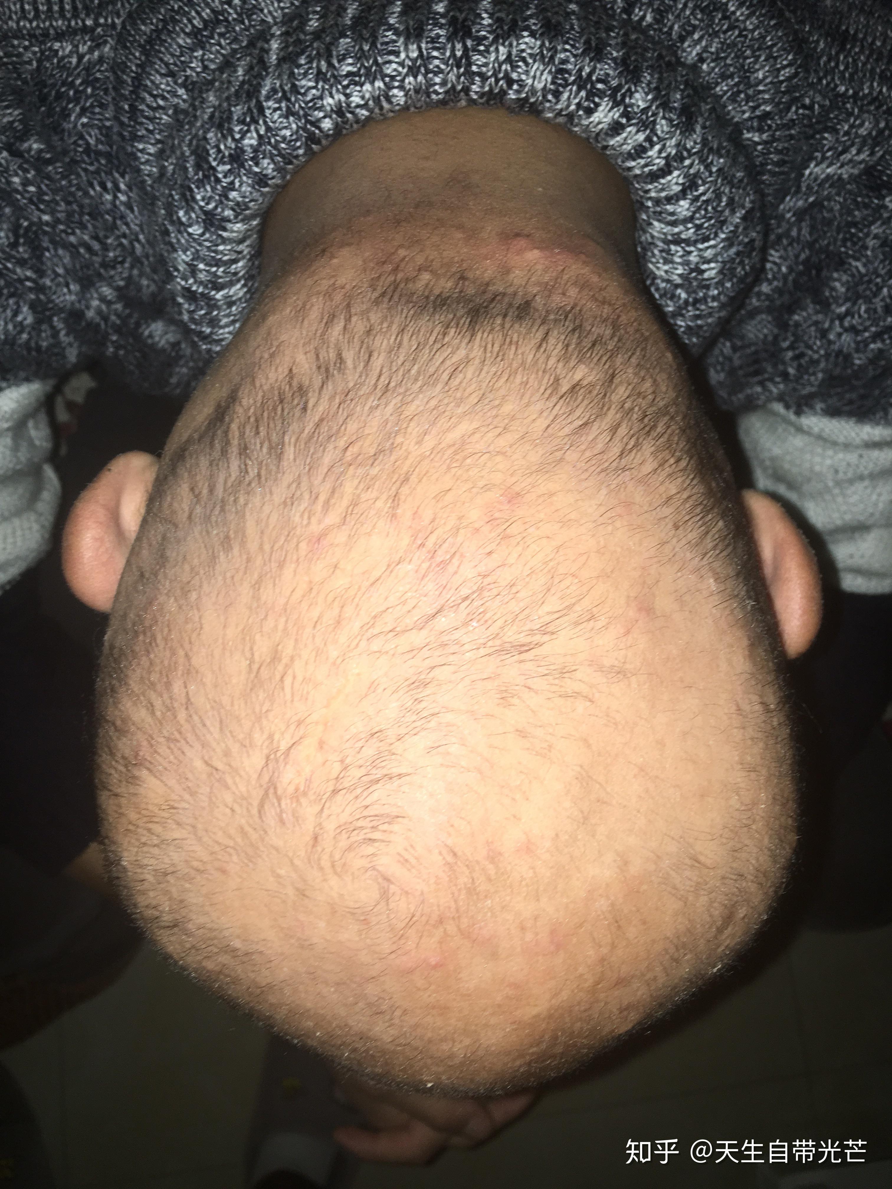 一名普秃男的恢复