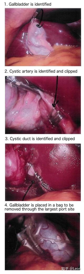 胆囊切除术cholecystectomy 知乎