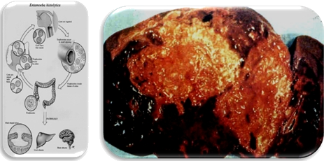 阿米巴肝脓肿脓液图片