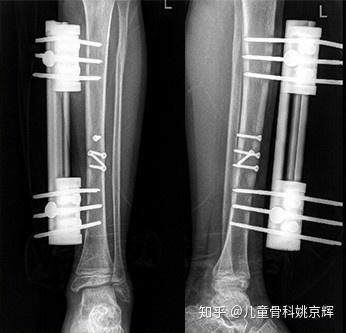 儿童骨折最常见的误区 你知道吗 知乎