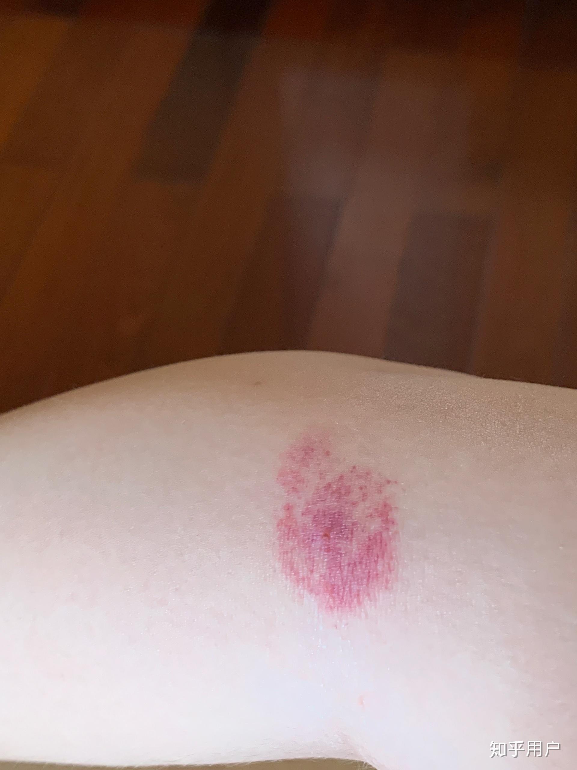 为什么我被蚊子咬了之后皮肤会变成类似淤青的紫红色,消退的很慢,肿的