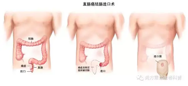 结直肠癌术后需要检查项目有哪些