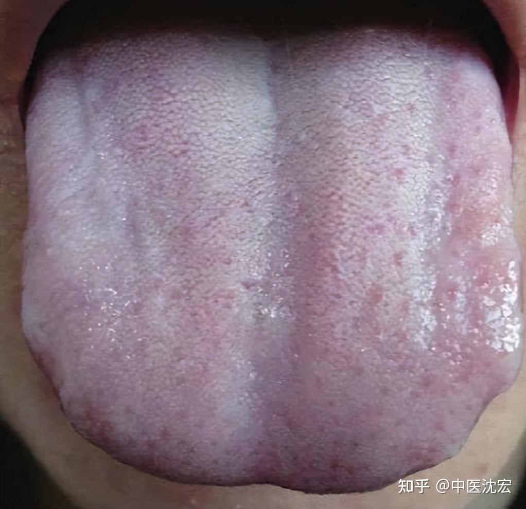 舌头中间有凹陷的图片图片