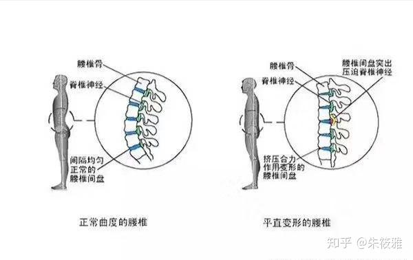 腰椎变直又伴骨盆前倾怎么矫正?
