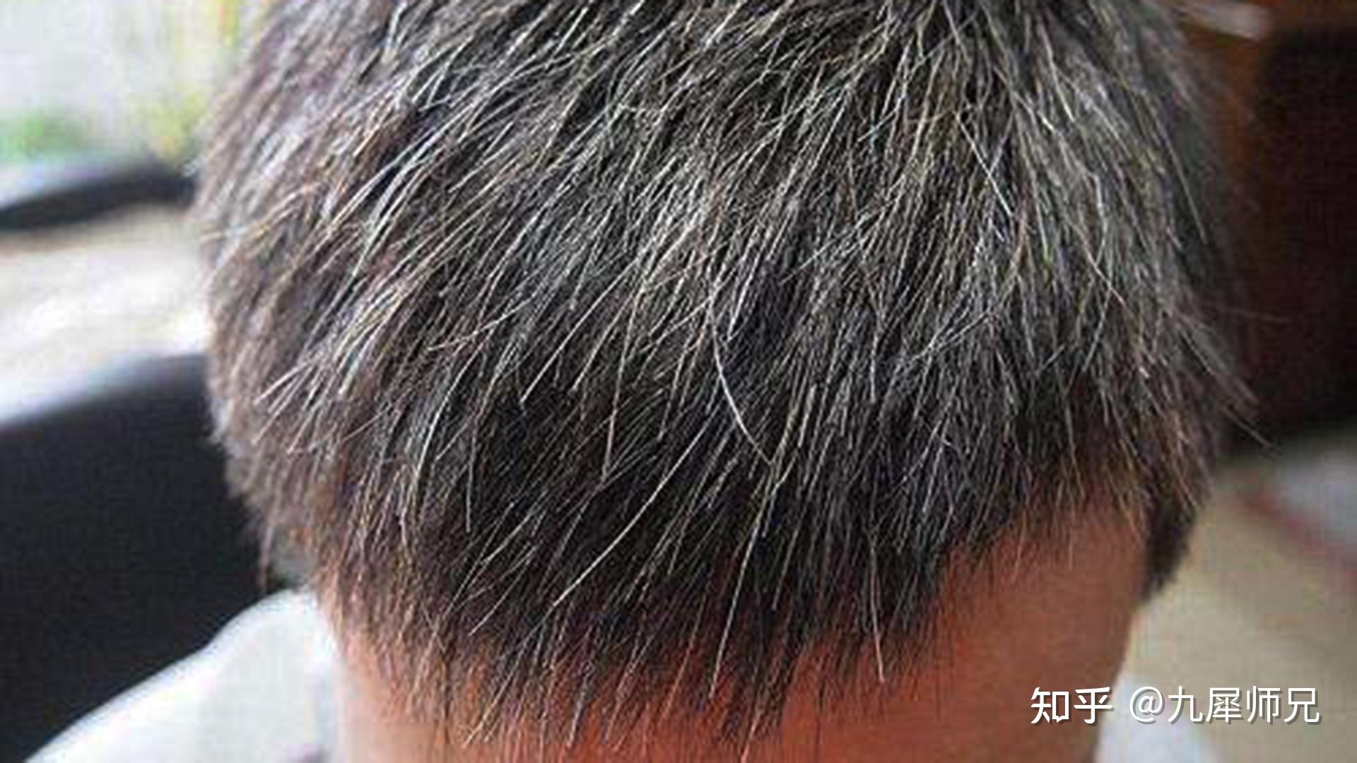 白发必看!不同部位白发以及黑发穴 - 知乎