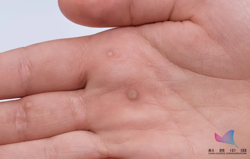 身上莫名长出的小揪揪皮肤病还是hpv感染了