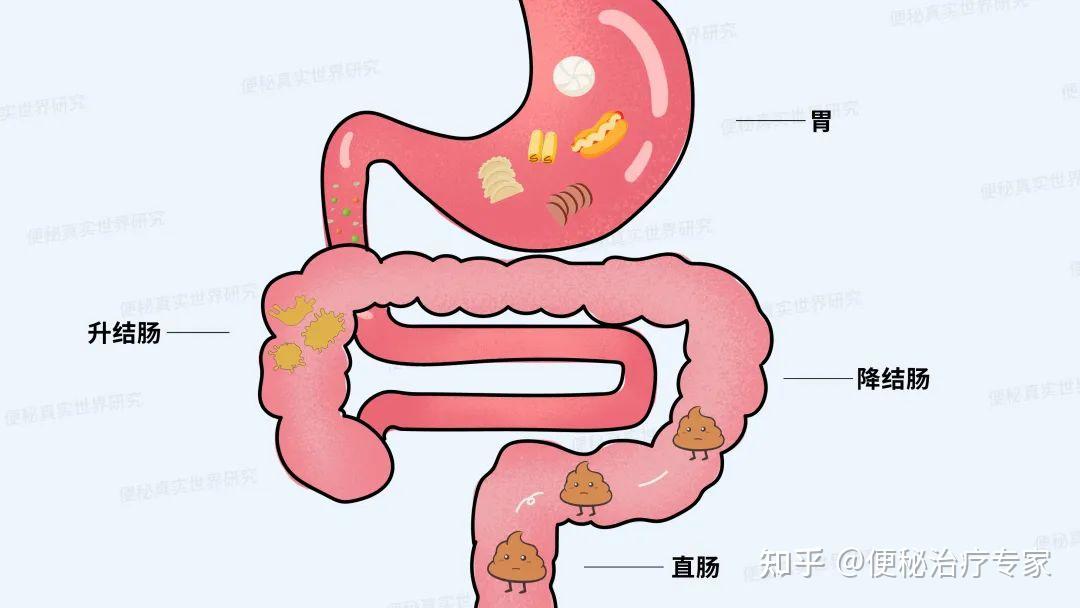 什么是慢传输型便秘?