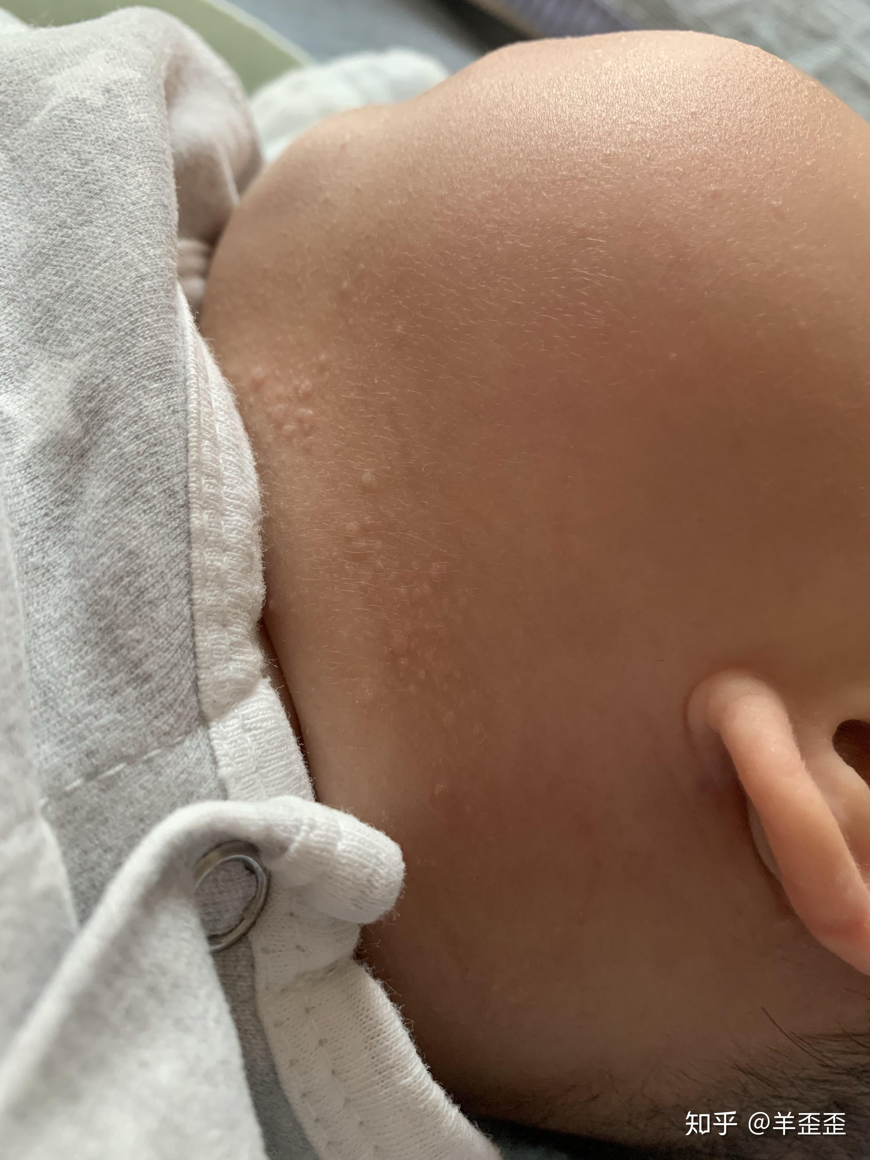 宝宝脖颈处湿疹图片图片
