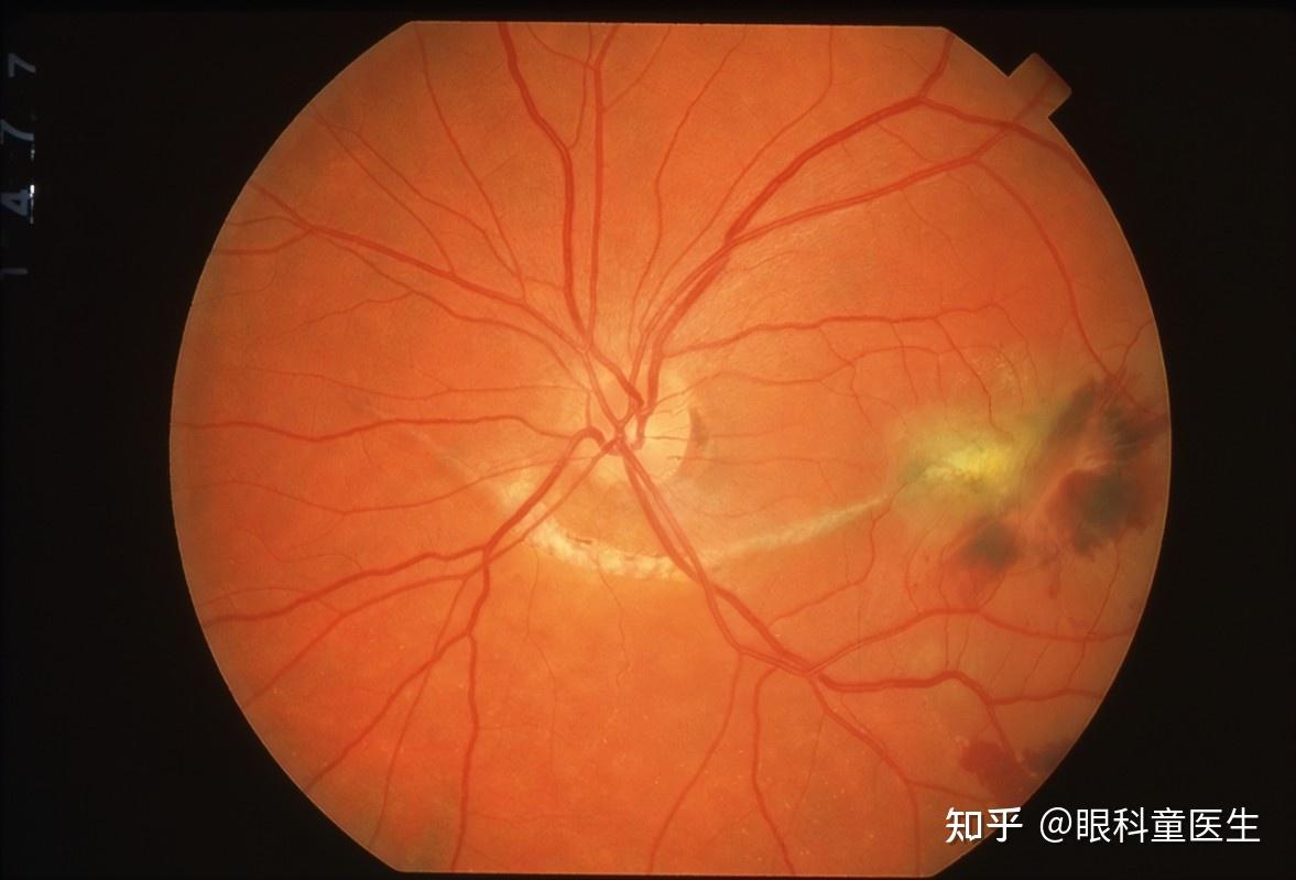 鉴别丨视网膜脱离、脉络膜脱离、玻璃体后脱离_锯齿