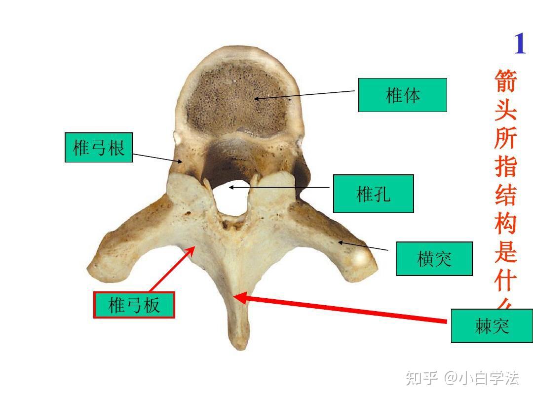 腰椎CT 3D - 梨子と坐骨神経痛