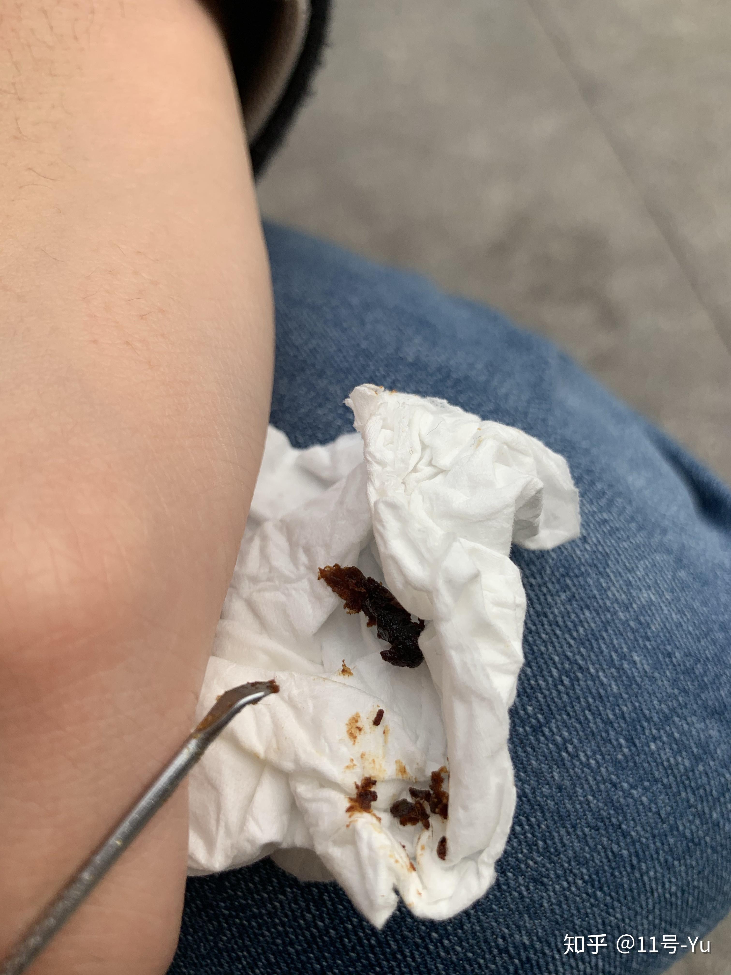 耳屎最大能有多大? - 知乎