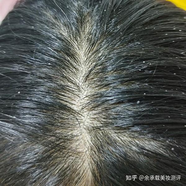 头皮上有毛囊炎适合哪种洗发水好用?去屑止痒洗发水测评 - 知乎