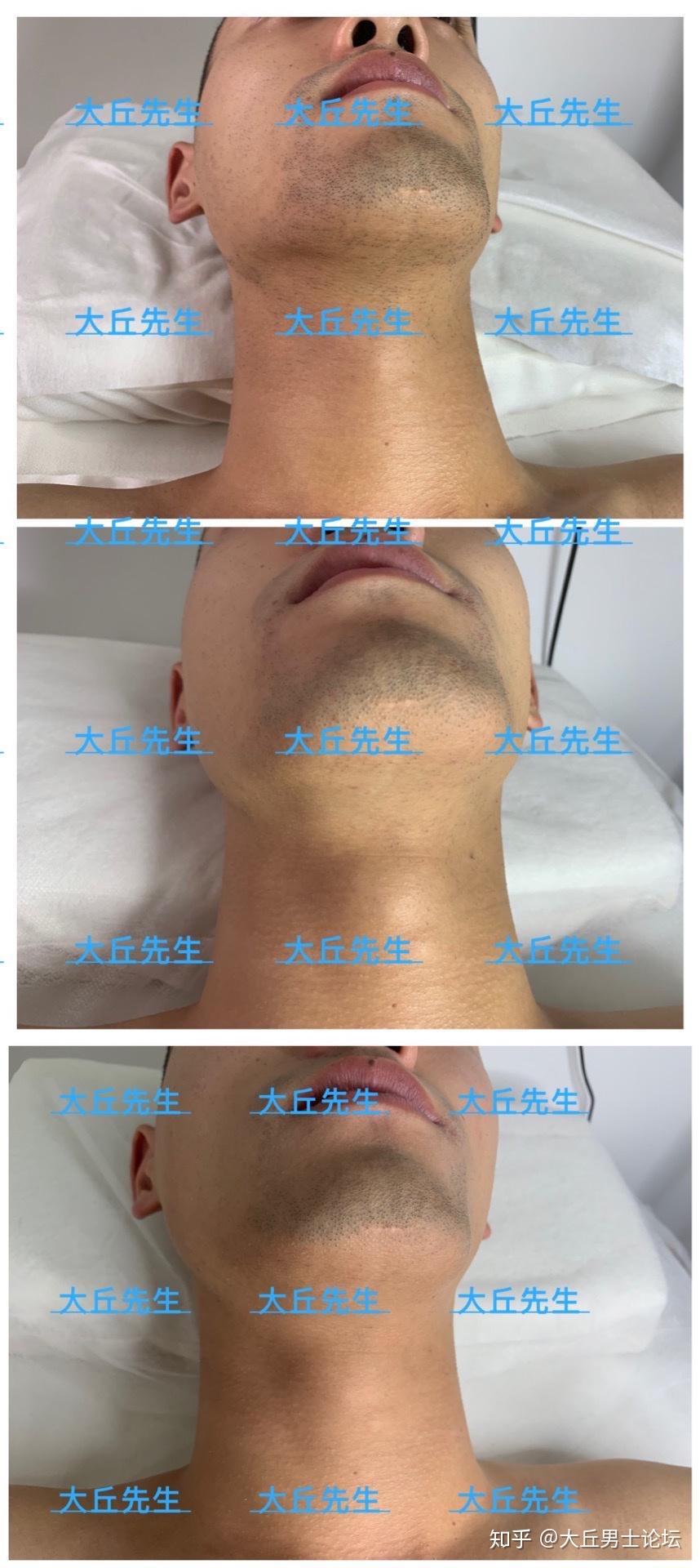 男士脸部胡须激光脱毛效果如何