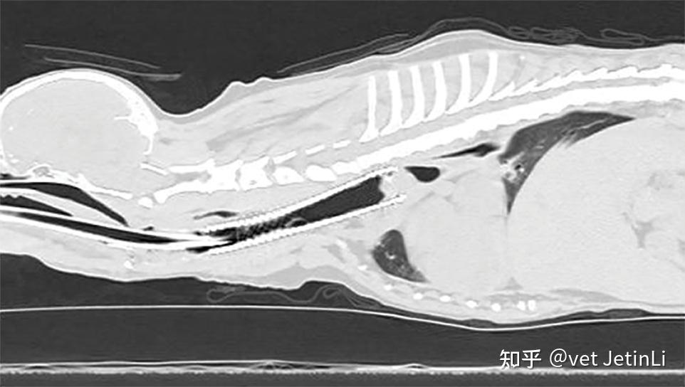 气管塌陷