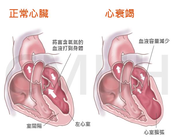 如何诊断心力衰竭 知乎