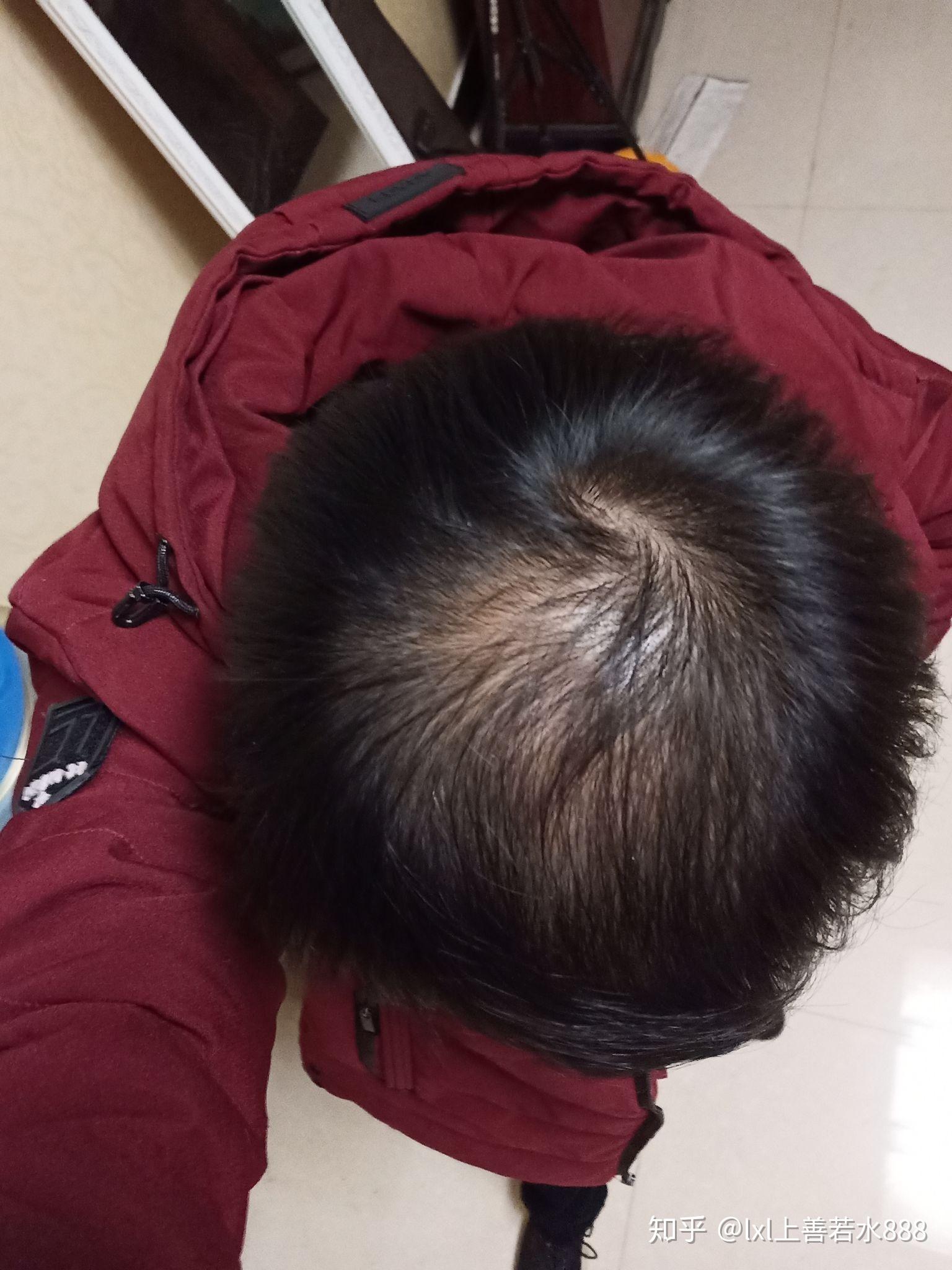 记录一下雄性激素脱发的恢复历程非那雄胺