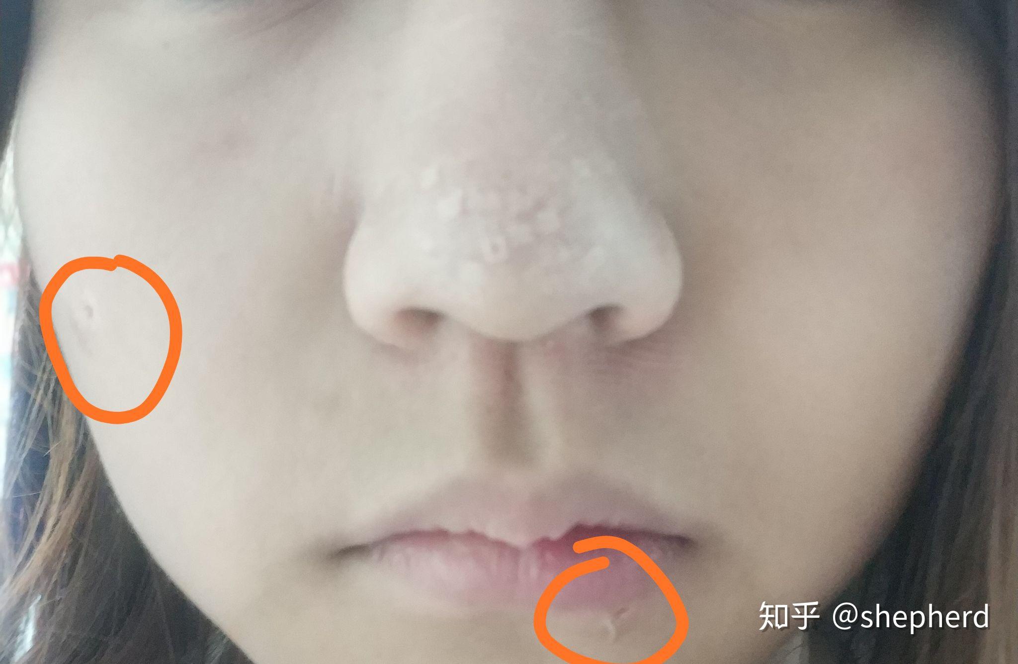 鼻子上凸起的增生痘疤怎么去除？ - 知乎