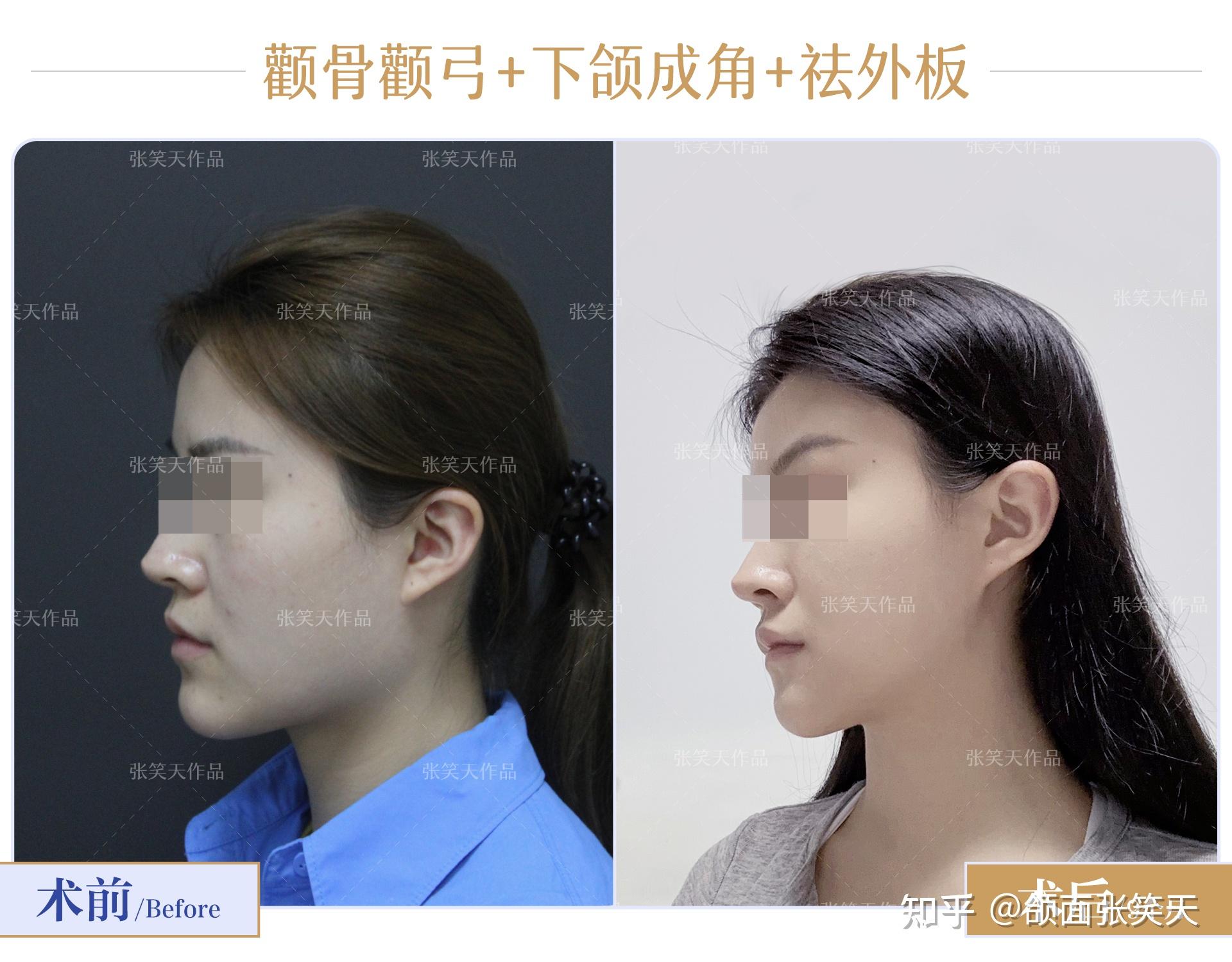 张笑天:颧骨颧弓+超长下颌角术后2个月,更显青春可爱 - 知乎