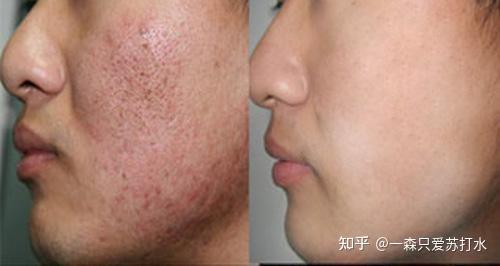 今天我针对性的讲一讲如何对于毛孔粗大的男生如何收敛毛孔.